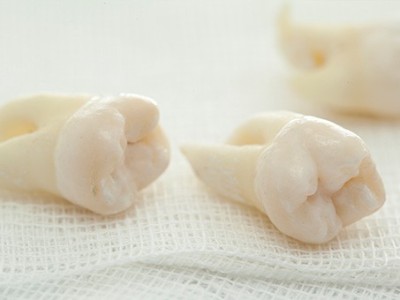 智齒疼了，這牙非拔不可嗎？