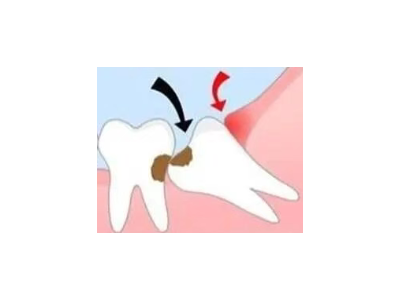 吃完飯后老塞牙？別大意！這可能是你的牙齒在報警