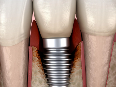 種植牙的術前準備有哪些？
