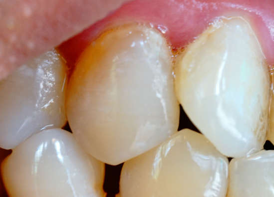 牙齒表面的牙釉質(zhì)掉了還可以修復(fù)嗎？