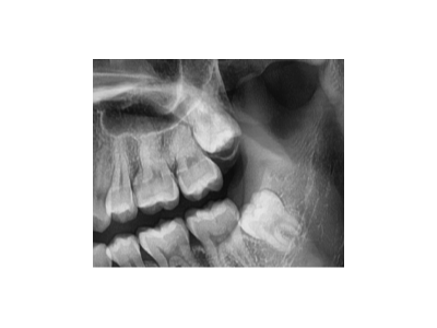既然「智齒」不宜久留，為什么不能一次性拔掉？