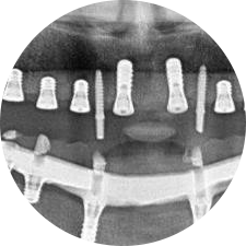 CAD/CAM義齒制作實現(xiàn)即刻修復(fù)