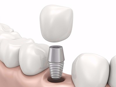 在承德哪家口腔醫(yī)院口腔種植齒好一點，惟德口腔醫(yī)院值得您的選擇